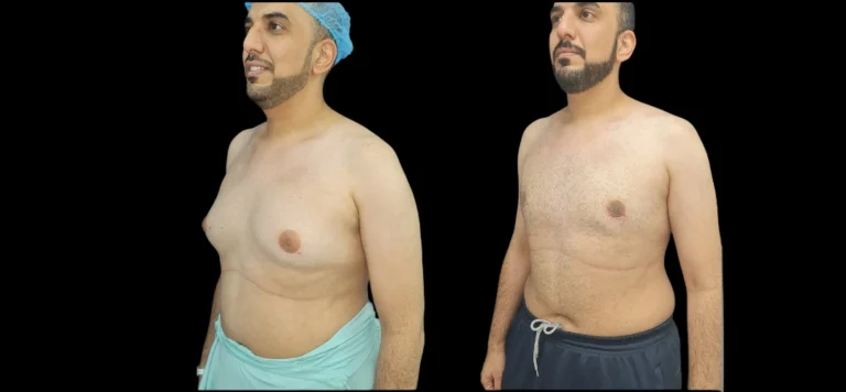 male showing breast reduction
